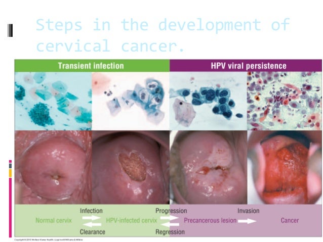 Human papillomavirus in women Human papillomavirus in women